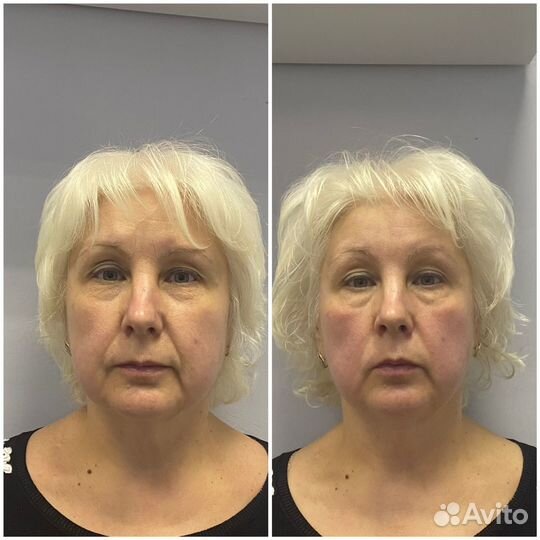 Массаж лица (разные техники)