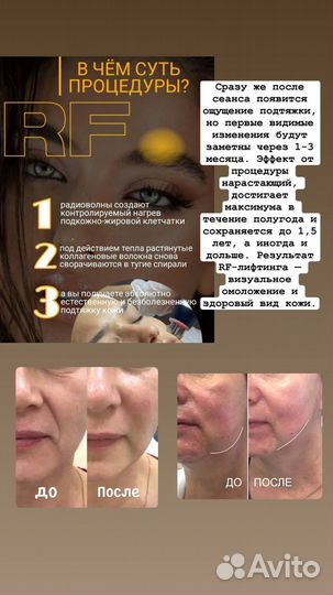 Косметолог, RF-лифтинг, УЗ чистка,мезотерапия