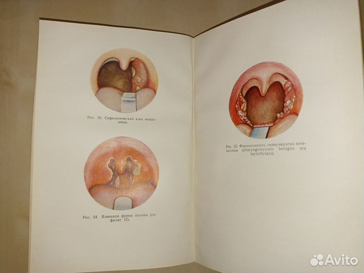 Острый и хронический тонзиллит. Лопотко. 1963