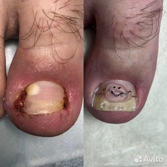 Подолог, педикюр