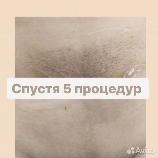 Лазерная эпиляция