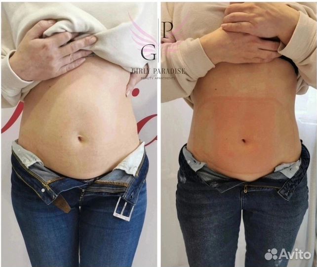 Криолиполиз