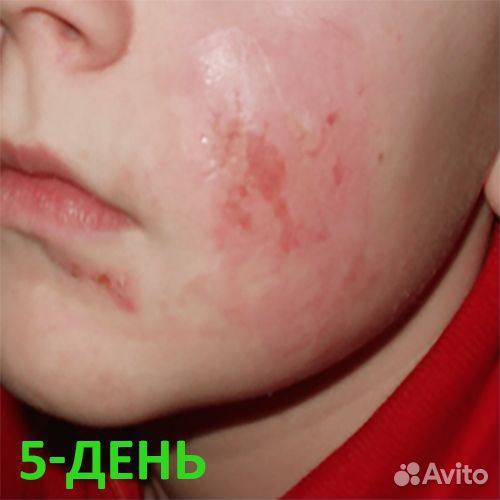 Ранозаживляющая защитная повязка 