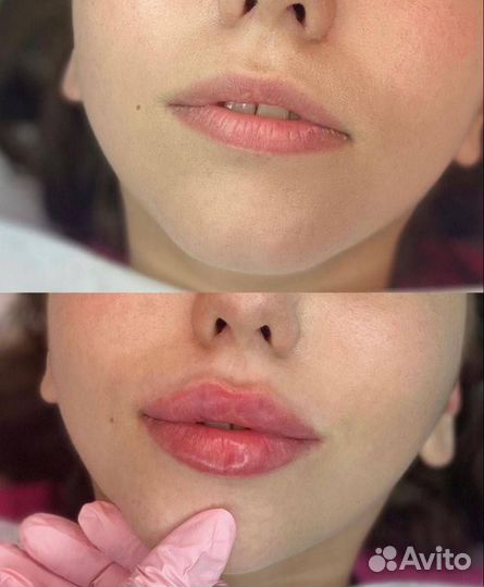 Увеличение губ контурная пластика губ косметолог