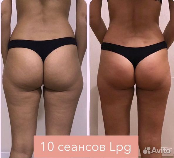 LPG массаж Кавитация Rf-лифтинг