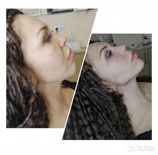 Увеличение губ