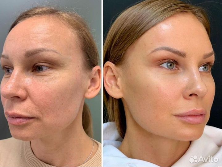 Модель на РФ лифтинг лица