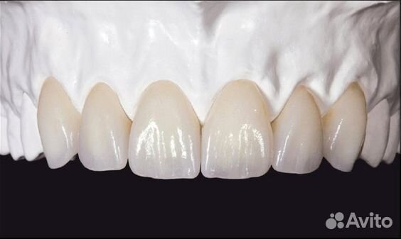 Керамические коронки