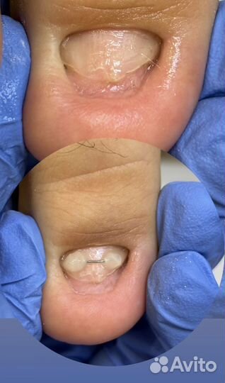 Восстановление ногтей из различных состояний