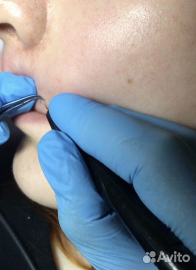 Курсы обучение электроэпиляции