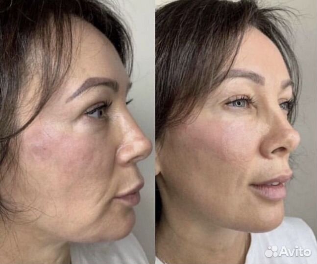 Омолаживающая мезотерапия лица безиньекционная