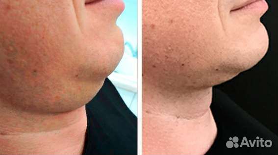 Криолиполиз