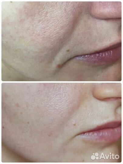 Буккально-скульптурный массаж лица