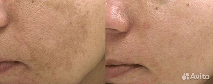 Убрать пигментные пятна, отбелить лицо даже летом