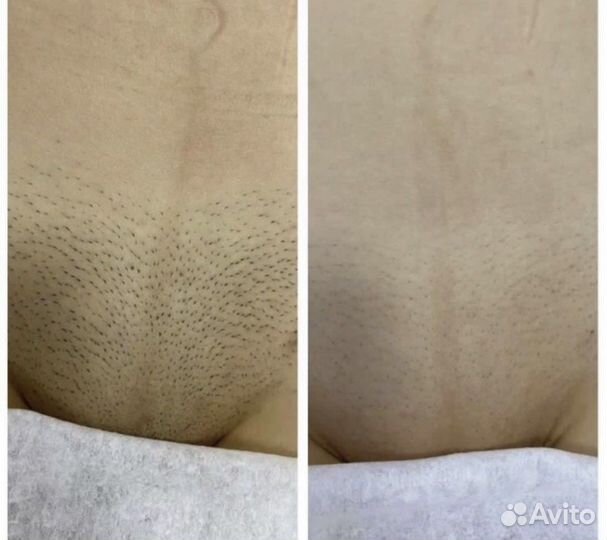 Лазерная Эпиляция