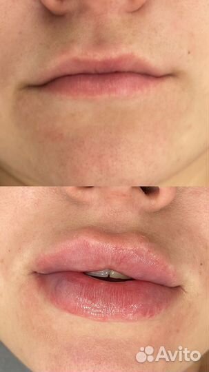 Увеличение губ