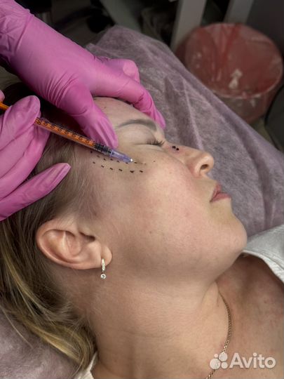 Ботокс лица, биоревитализвция, мезотерапия