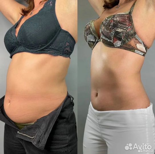 Супер Быстрое Сжигание Жира Криолиполиз 4D