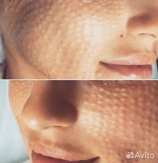 Безоперационная подтяжка лица, РФ лифтинг