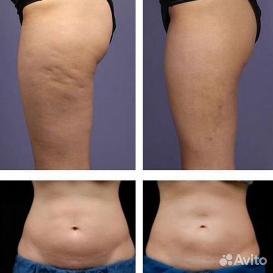 Антицеллюлитный массаж