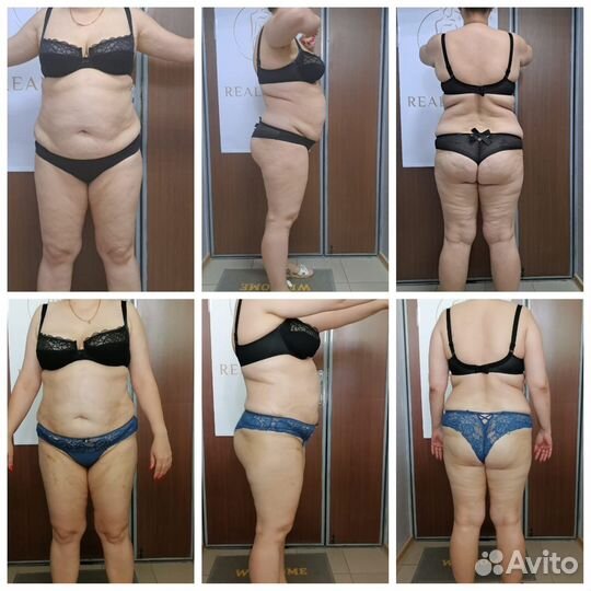 Коррекция фигуры Волгоград