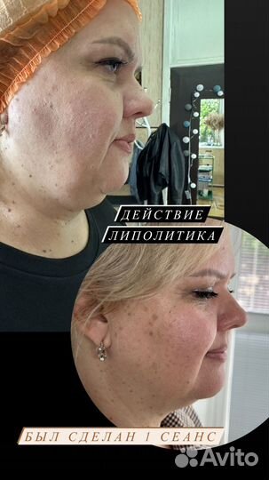 Липолитики по лицу