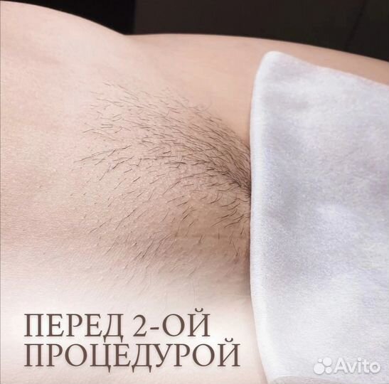 Шугаринг в Динской
