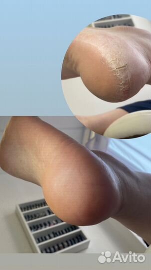 Медицинский педикюр. Подолог