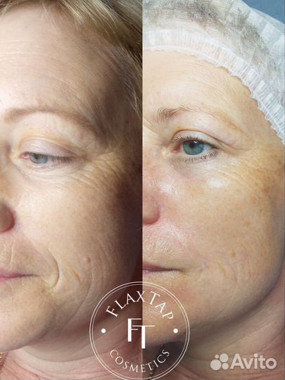 Косметолог без иголок