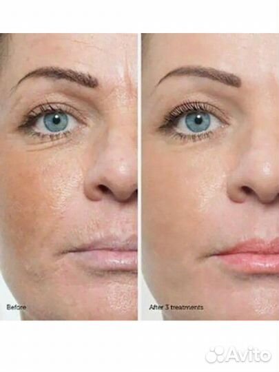 Биоревитализация