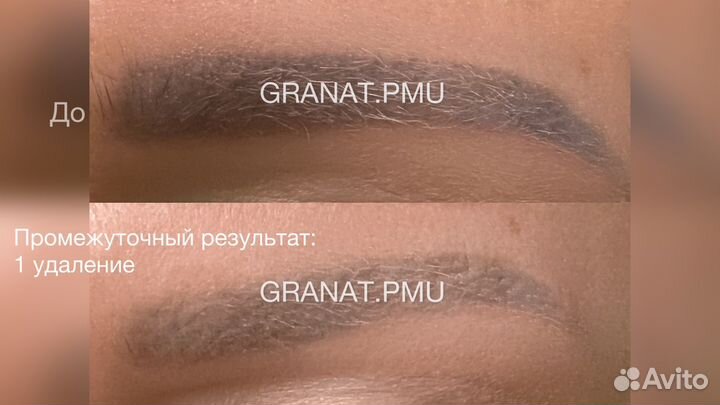 Лазерное удаление перманента и татуажа бровей