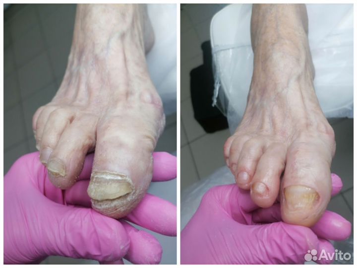 Сертифицированный подолог, лечебный педикюр