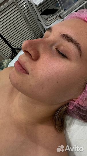 Чистка лица глубокий пилинг в подарок