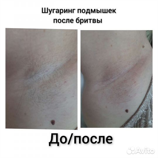 Шугаринг, ваксинг