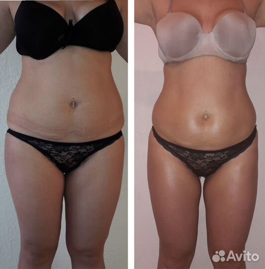 Антицеллюлитный массаж