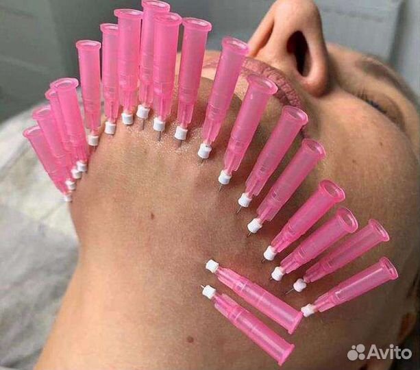 Мезонити (Тредлифтинг)