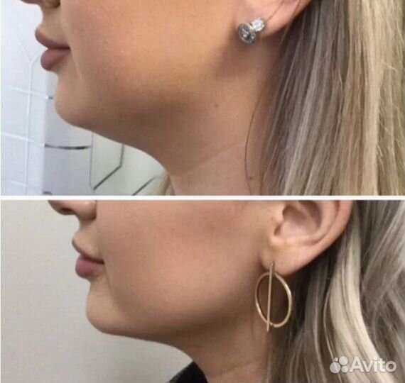 Жиротоп Кавитация, RF лифтинг