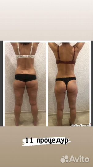 Антицеллюлитный массаж коррекция фигуры