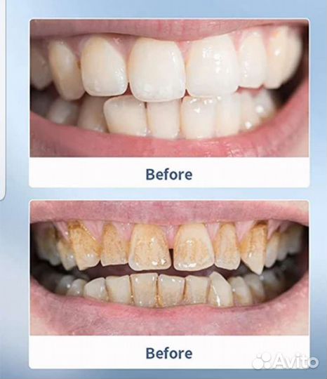Ультразвуковой прибор для очистки зубов от налета