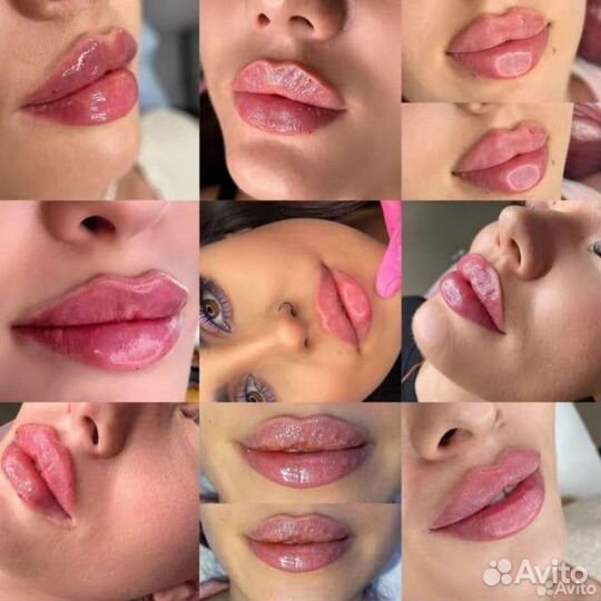 Увеличение губ