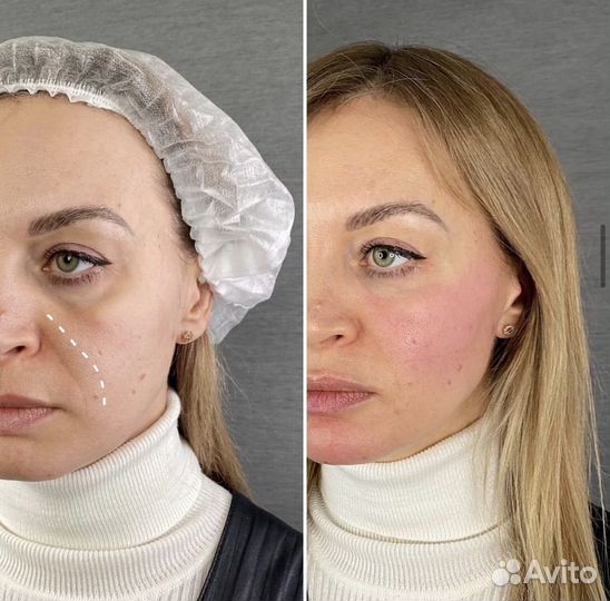 Скульптурный массаж лица