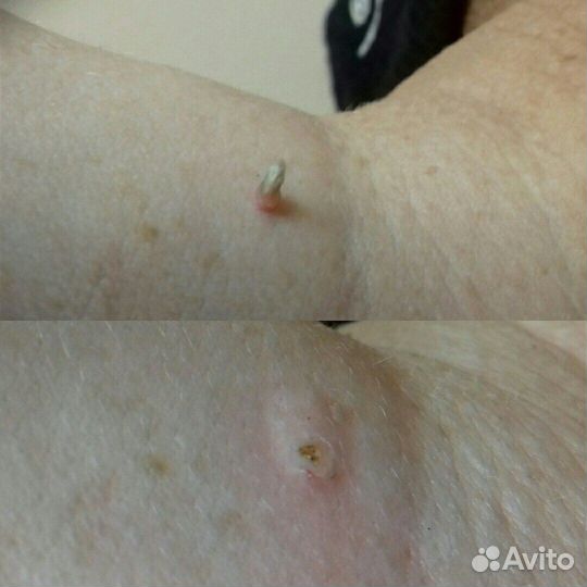 Удaлeние пaпиллом, родинoк, бoродавок