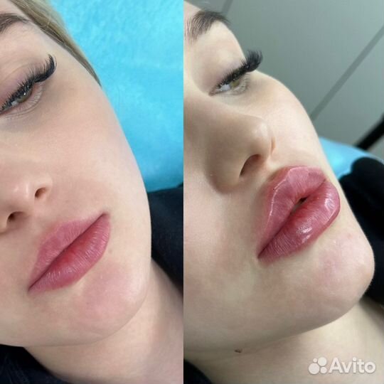 Увеличение губ