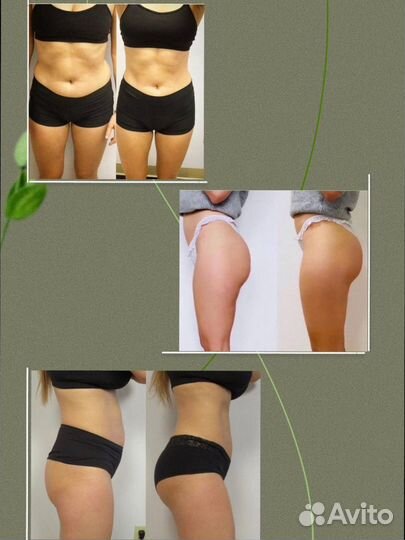 Аппаратное похудение EmsCulpt