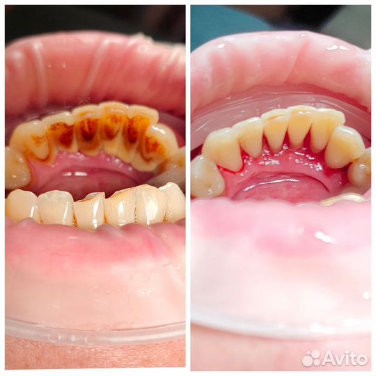 Сертификат на снятие зубных отложений