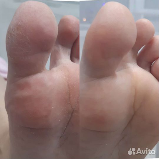 Аппаратный педикюр