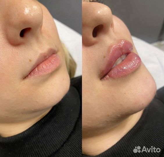 Контурная пластика губ