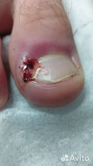 Подолог,вросший ноготь, стержневые мозоли