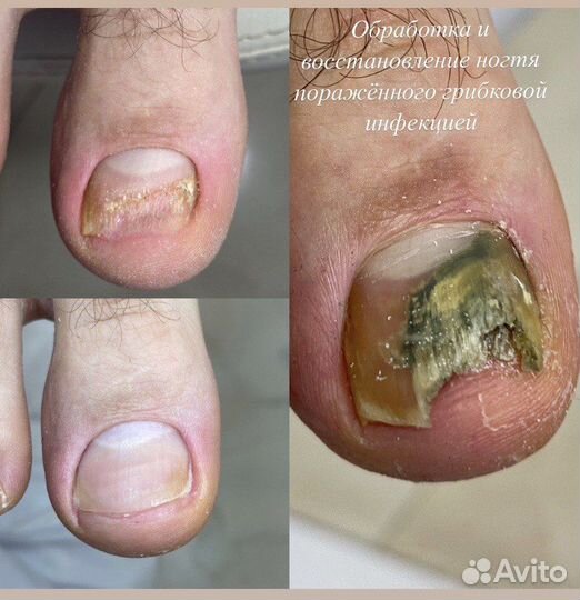 Подолог. Вросший ноготь. Мозоли. Грибок. Ортез