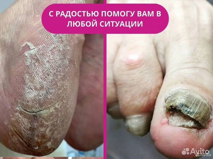 Лечение вросшего ногтя. Здоровый ноготок за 4 сеан